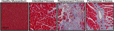 The Dynamic Interplay Between Cardiac Inflammation and Fibrosis